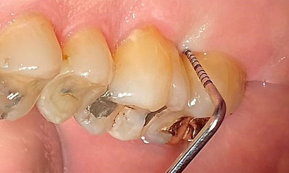 Сондиране за документиране на резултатите медиопалатинално на зъб 27.