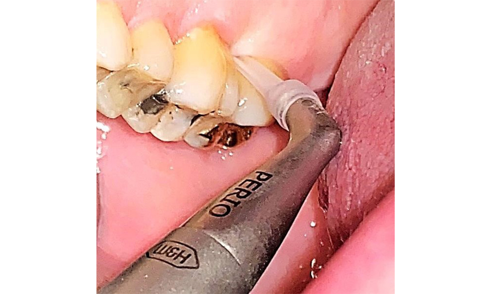 Subgingival application of the flexible air polisher tip (Proxeo Aura, W&H, shown here) to the mesiopalatal aspect of tooth 27 with a periodontal pocket depth of 5 mm. 