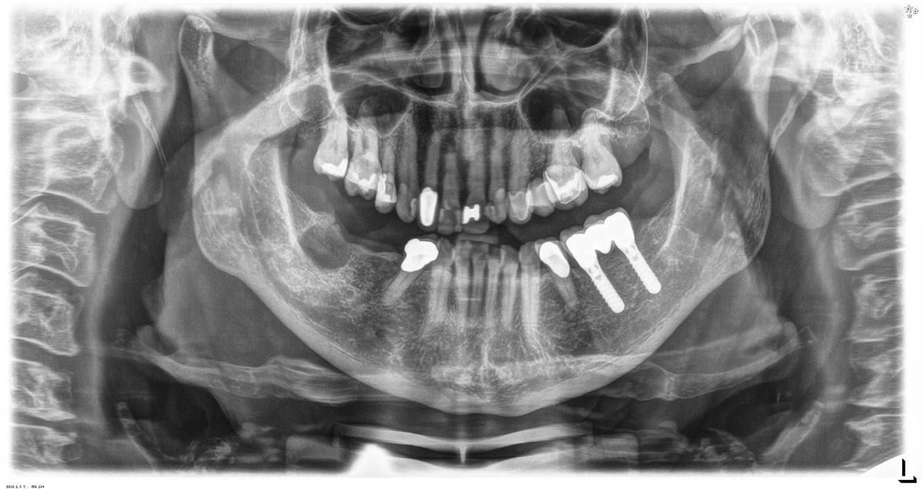Paciente sana con enfermedad periodontal previa