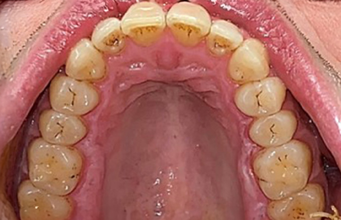 The endocarditis patient with active caries lesions