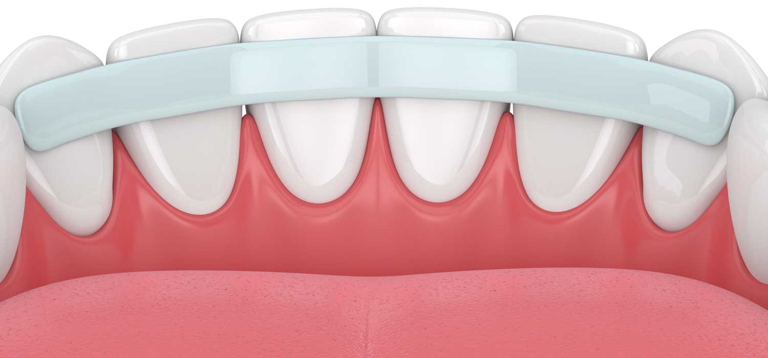 When does it make sense to splint teeth?