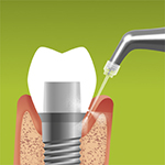 Ošetření periimplantitis