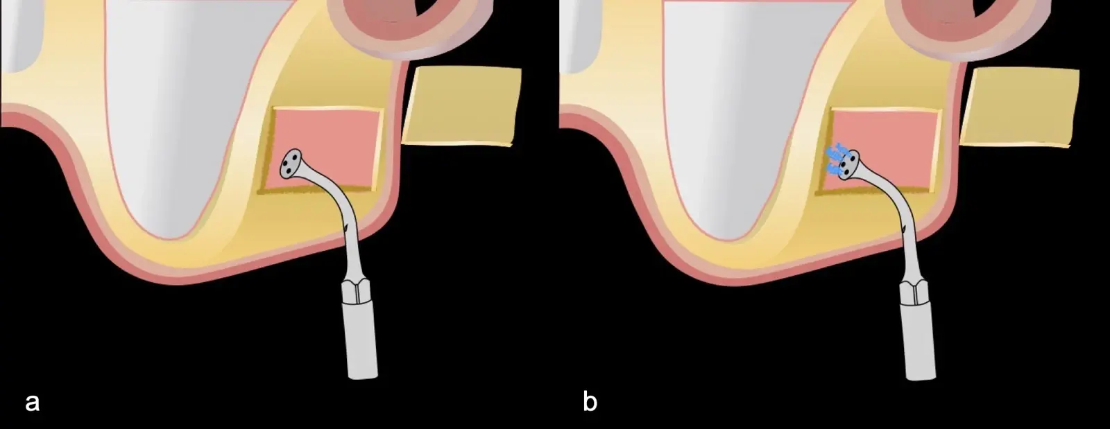Inserto de presión hidráulica iniciando el desprendimiento de la membrana de Schneider (a, b ).