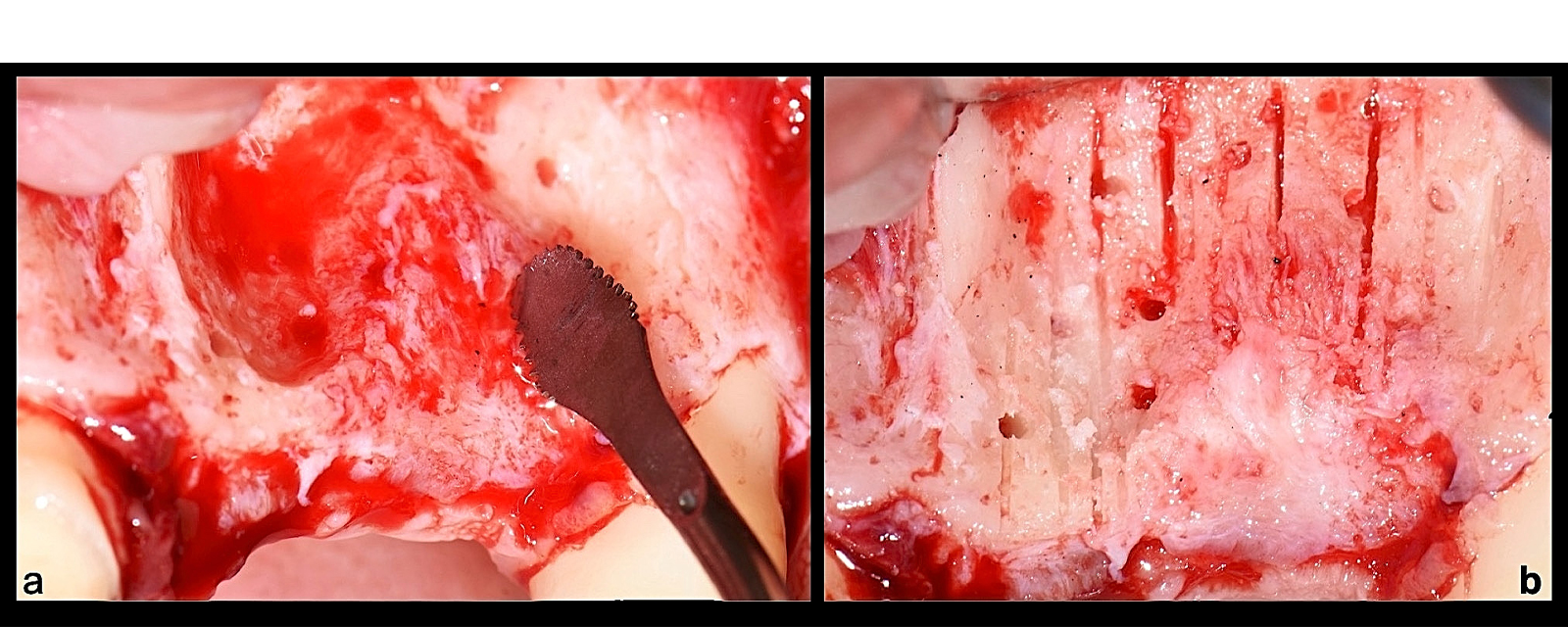Use of the flat serrated piezo insert (B6 by W&H) for extended decortication (a). Vascularisation and nutrition grooves (b).