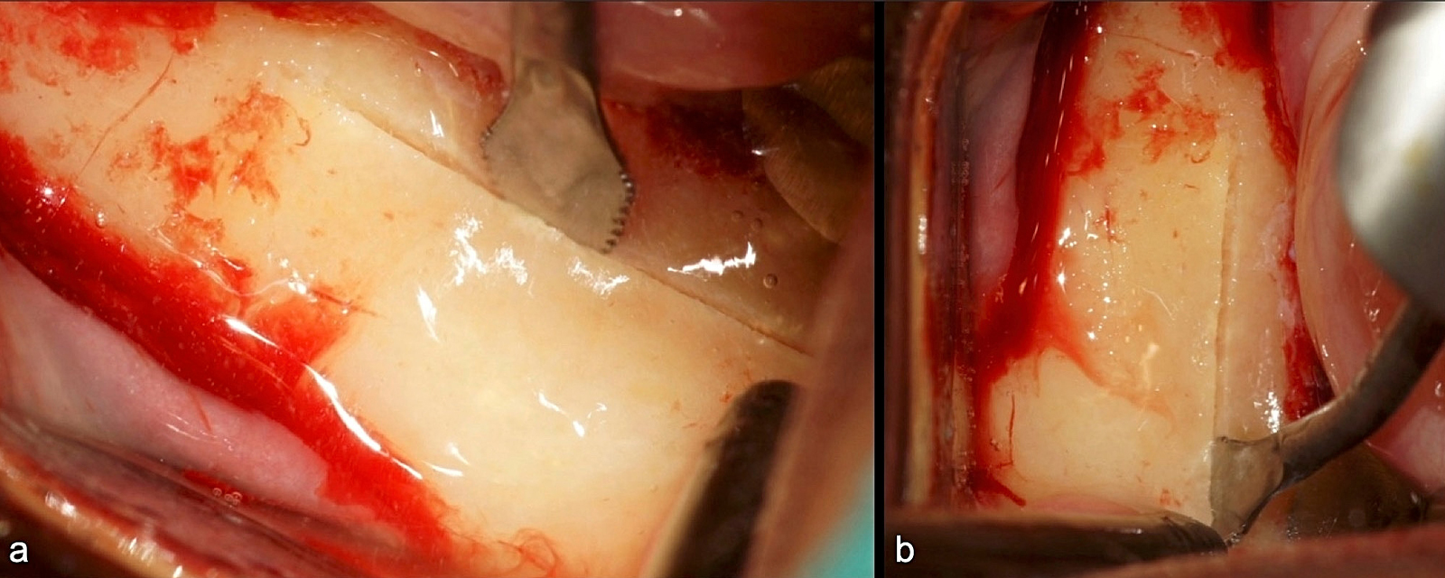 Spenderareal: Osteotomie-Winkel mit Piezosäge (B6 von W&H) zur Abgrenzung des Knochenblocks (a, b).