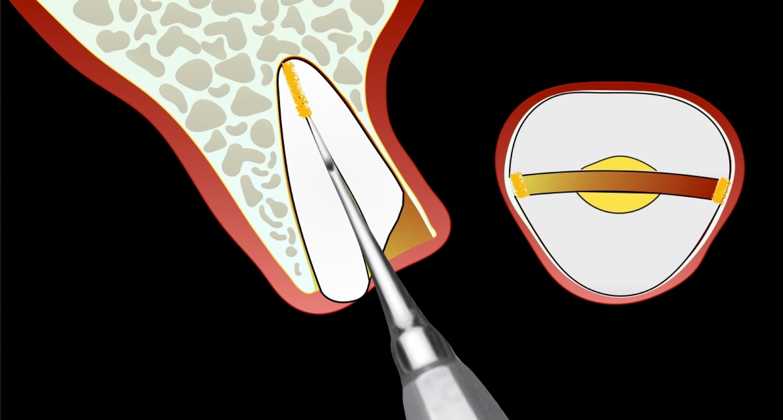 Fracturarea restului radicular în două segmente: vestibular și palatal.