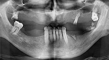 residual dentition 