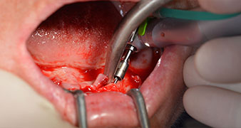 pilot drilling with W&H contra-angle