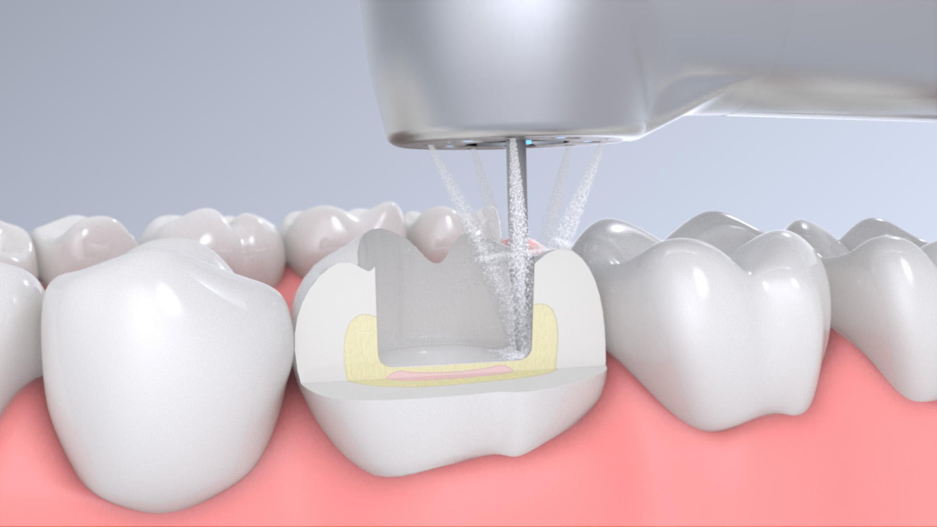 Welchen Zweck hat der Wasserspray in dentalen Schnelllaufwinkelstücken?
