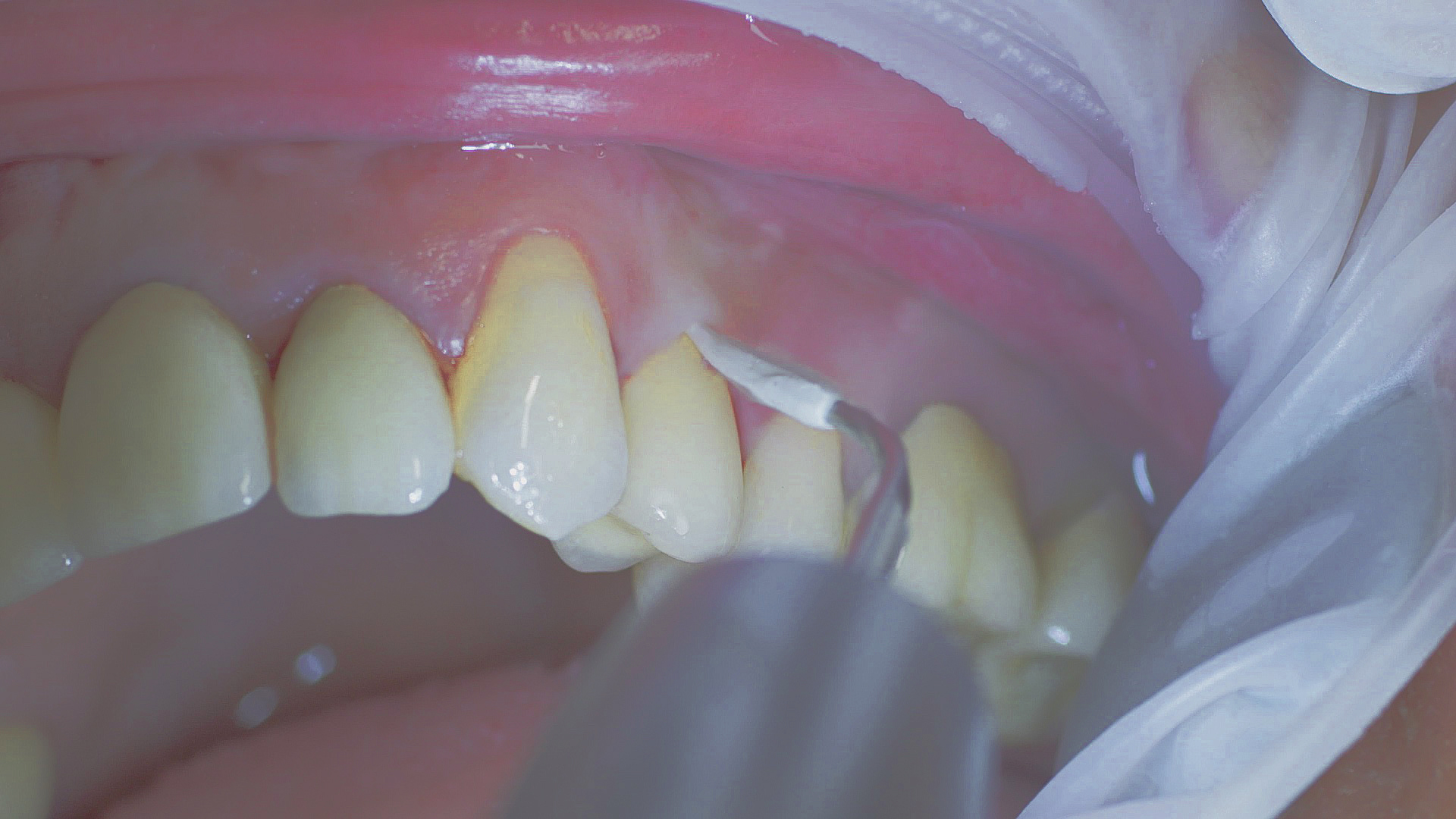Implants and suprastructures are routinely cleaned