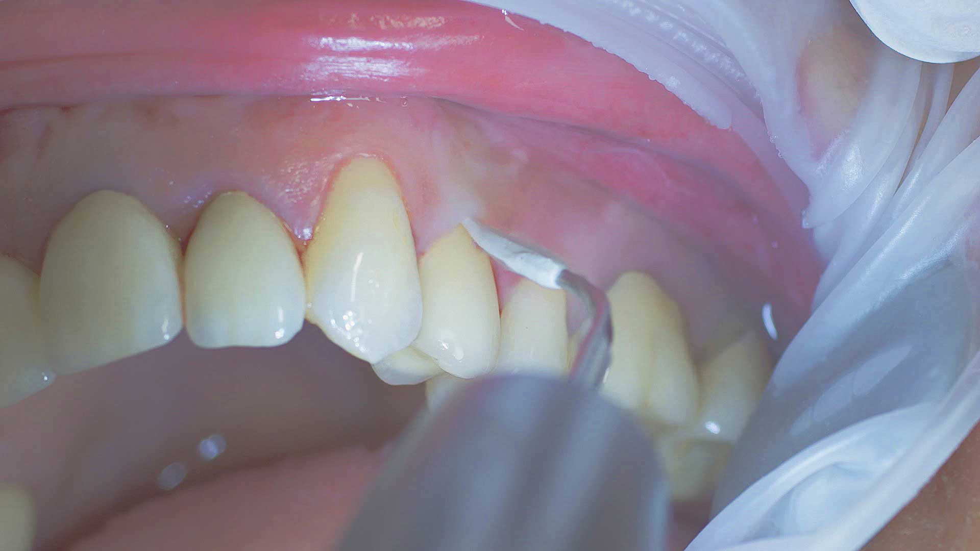 La gama de puntas de W&H se ha desarrollado en estrecha colaboración con usuarios finales. En la imagen, puede verse la punta W&H 1I con revestimiento de PEEK para tratar la mucositis.