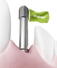 Osstell ISQ