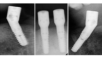 Implantes