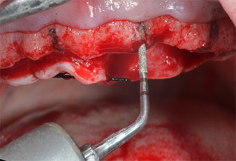 Insert marqueur à ultrasons Piezomed