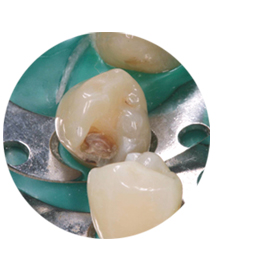 //a.storyblok.com/f/45617/1ca0f82b6f/tooth-without-facelight.jpg