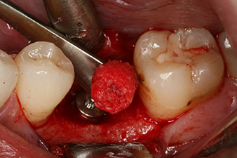 periimplantario con virutas de hueso autógeno