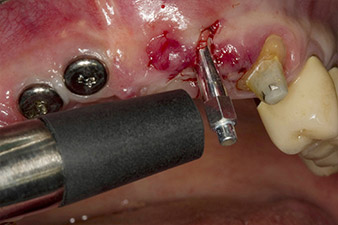 Osstell ISQ module