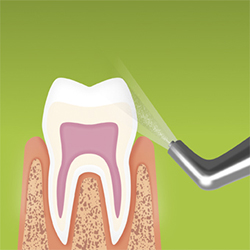 Supragingival