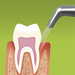 Supragingival