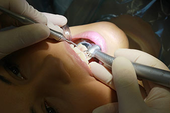 Turbina Synea Vision di W&H con anello a LED+ con 5 diodi luminosi