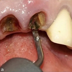 Figura a: Sindesmotomía utilizando el periótomo del piezoeléctrico. 