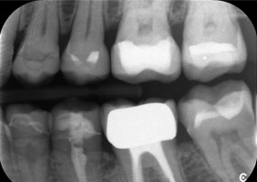 A x-ray, showing teeth and a zirconia crown, in front of a black background.