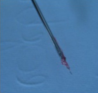 Abb. 3 u. 4: Zustand nach Revision des Wurzelkanals und Darstellung des frakturierten Instruments.