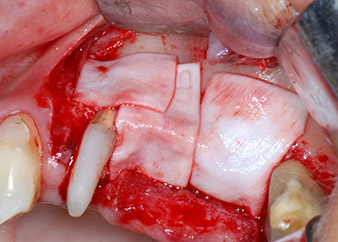 absorbable collagen membrane