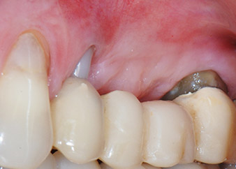 Two months after the surgery, the patient was pain-free.