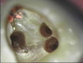 Abb. 2: Darstellung aller Wurzelkanaleingänge. Die palatinale Wurzelfüllung wird belassen, da sie für gut befunden wird. 