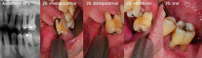 Geschlossenes Debridement der Furkationen an 26 und 36 