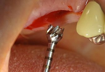 Instruments for the depth-defined preparation cut