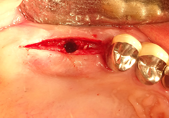 La membrane de Schneider est étirée sur 1,5-2 mm au-dessus de l’abord osseux.
