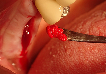 À l'aide d’une rugine, un mélange d’augmentation est soigneusement placé dans la région de l’ostium du sinus maxillaire interne, dans la direction apicale.