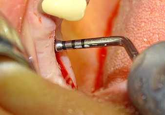 The Schneiderian membrane is carefully detached with the Z25P instrument (phase 1)