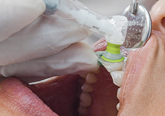 The adaptation of the polishing cups to the tooth surface is very good and the thin, nubless edges of the cups render the cleaning of the sulcus region comfortable. The transparent design of the disposable prophy handpieces gives an hygienic impression.