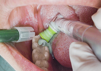 Also hard-to-reach areas such as tubers, molars and the line angle region can be accessed well.