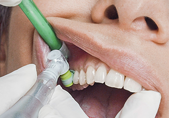 The cups also reach the interdental spaces and the nubs simultaneously clean adjacent teeth and diminish splattering of the paste.