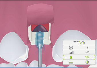 Représentation schématique de l’élévation finale de la membrane : L'alimentation en fluide de refroidissement autour de l’insert et la cavité créée sous la membrane sont illustrées.