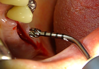 Le site implantaire est élargi à 3,0 mm à l'aide de l’insert I3A (puissance 100 %, fluide de refroidissement 80 %). Les repères de profondeur garantissent de ne pas dépasser une certaine profondeur pendant la préparation.