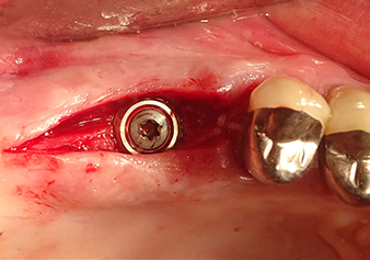 Situation after insertion of the implant