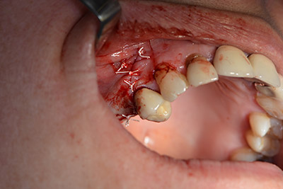 saliva-proof wound closure