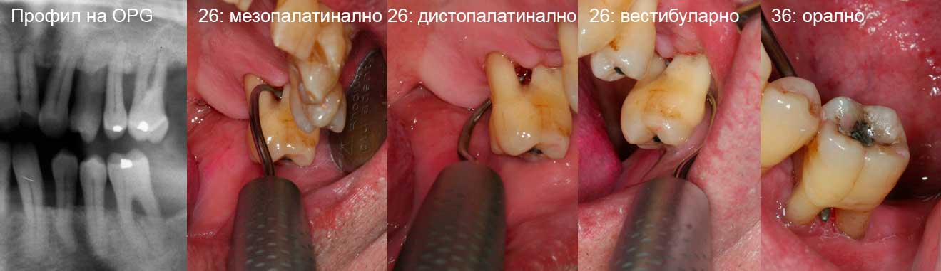 Затворено отстраняване на фуркациите на зъби 26 и 36