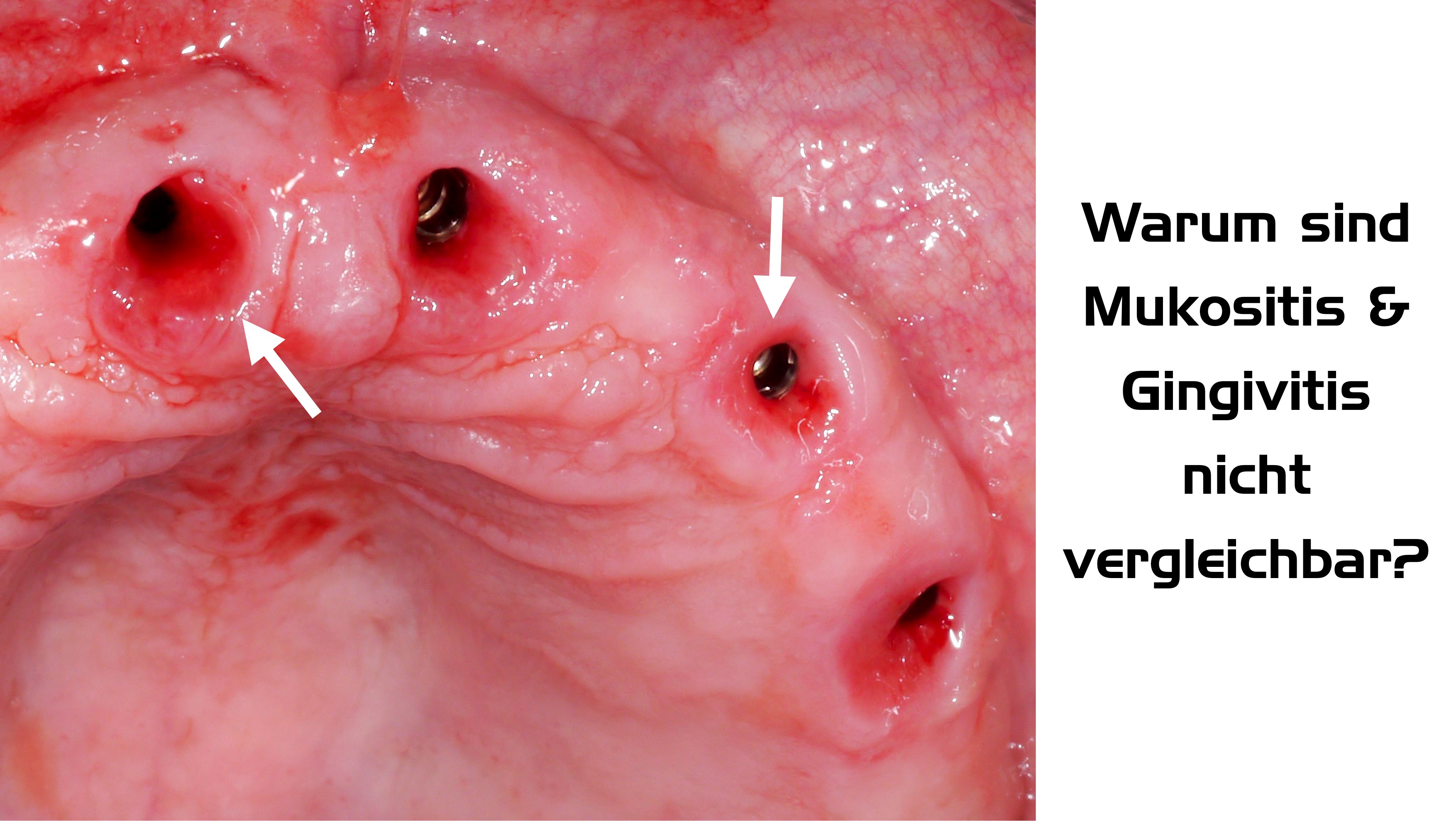 Warum sind Mukositis und Gingivitis nicht vergleichbar? (Shutterstock)