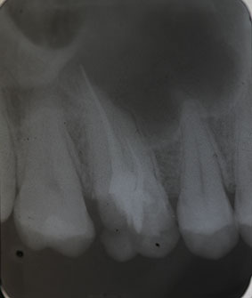 Abb. 1: Ausgangsröntgenbild des insuffizient gefüllten Zahnes 16. 