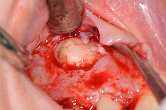 retrograde Endodontie