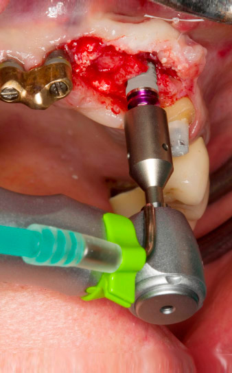 Motorized placement of the implant 
