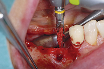 Implantation with Implantmed is simple and reliable