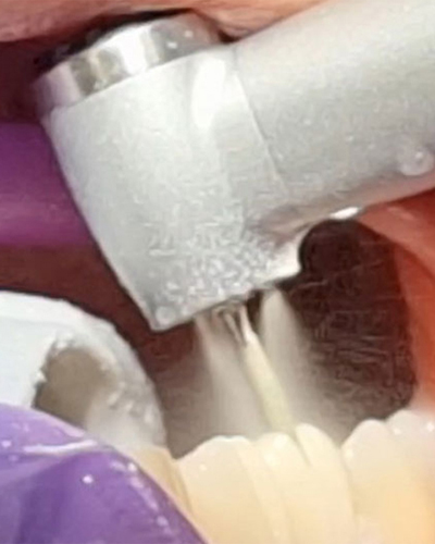 Synea Power Edition handpiece cooling: Effectively maintaining a lower temperature with coolant flow.