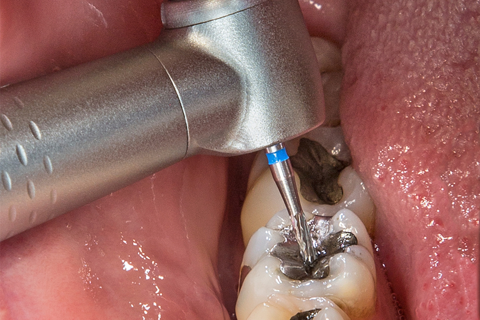 Removal of amalgam fillings
